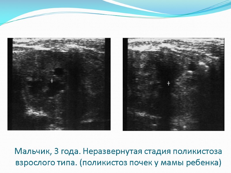 Мальчик, 3 года. Неразвернутая стадия поликистоза взрослого типа. (поликистоз почек у мамы ребенка)